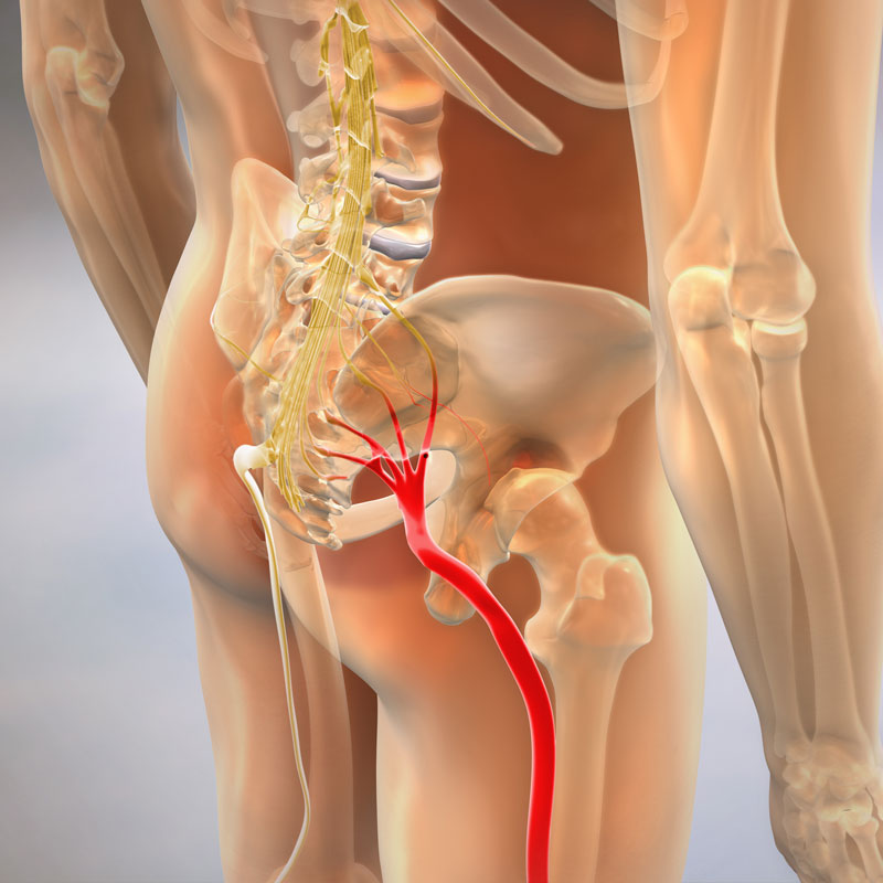 Sciatica Pain