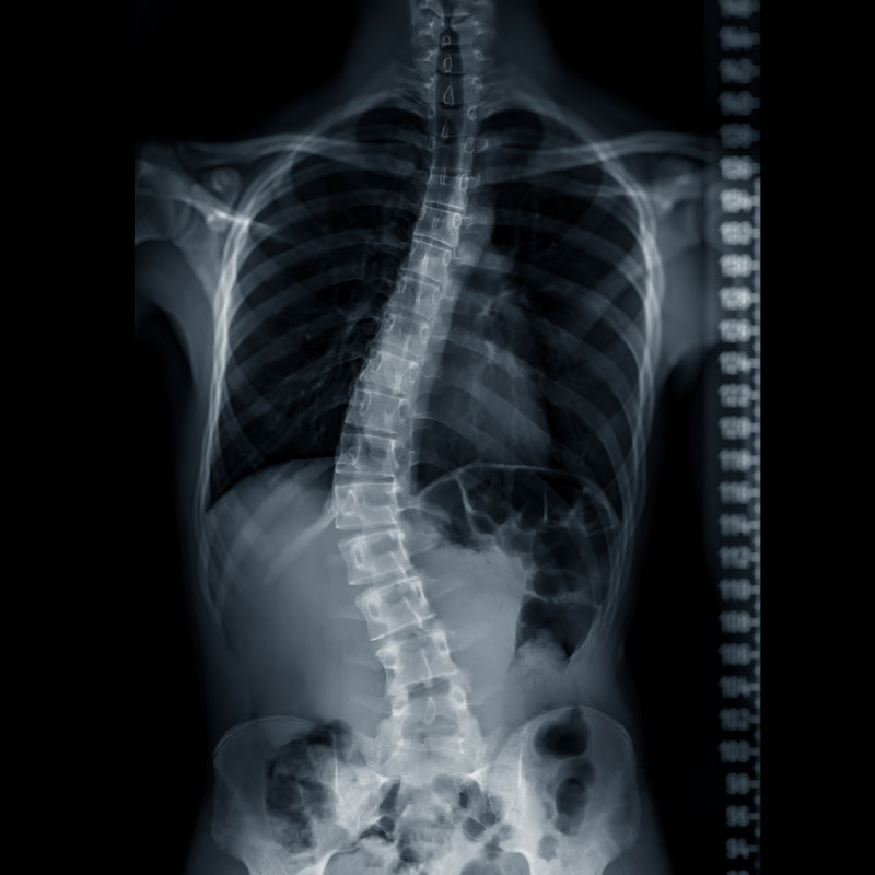 Scoliosis